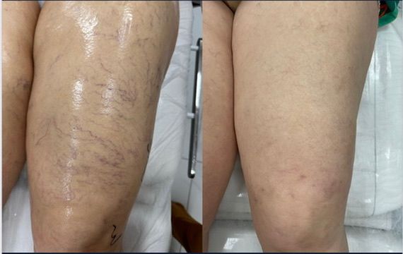 Antes e depois do tratamento de varizes — Vasinhos finos — coxa