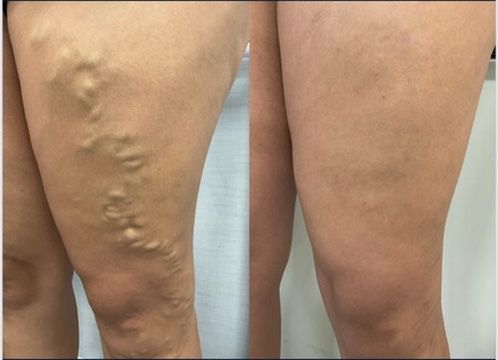 Antes e depois real do tratamento de varizes na coxa