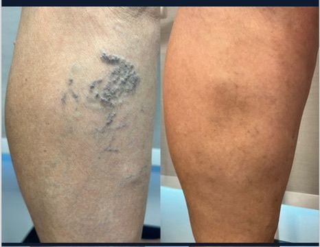 Antes e depois do tratamento de varizes — Vasinhos finos — panturrilha