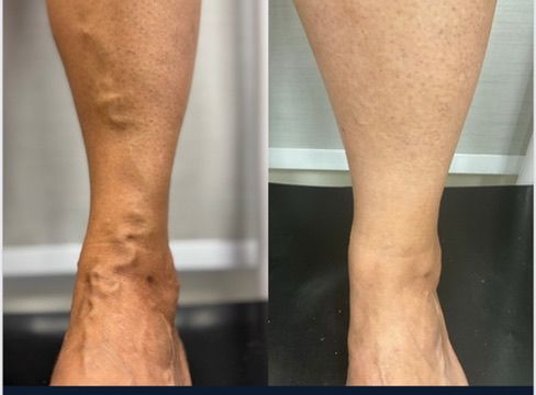 Antes e depois do tratamento de varizes — Varizes grossas — perna e tornozelo
